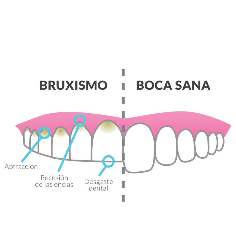 Bruxismo nocturno: cómo evitar el desgaste dental
