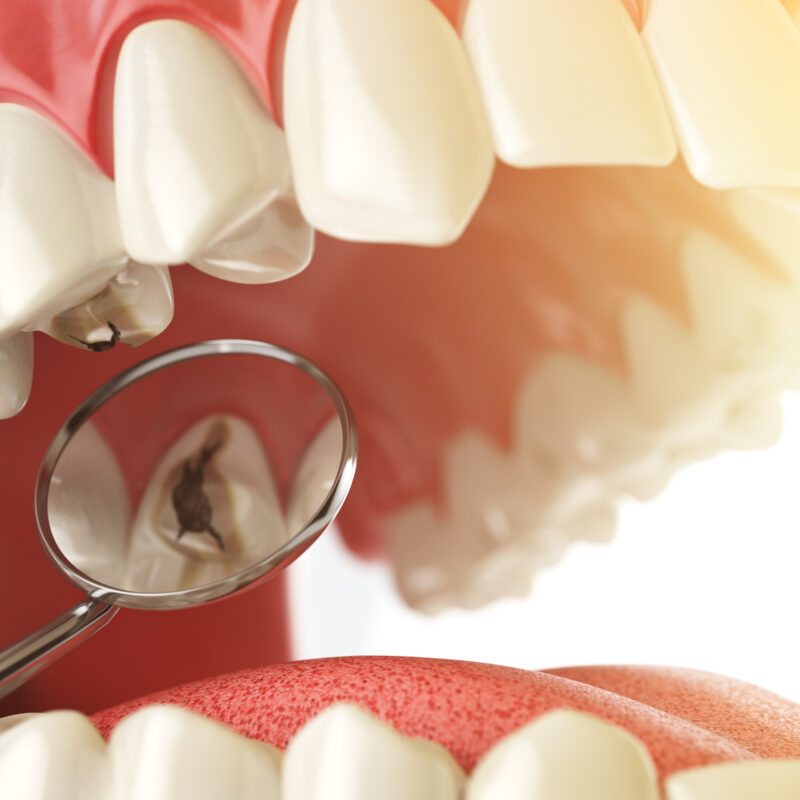 Tratamiento de una caries en la Clínica dental Lucrecia Botella de Torrevieja
